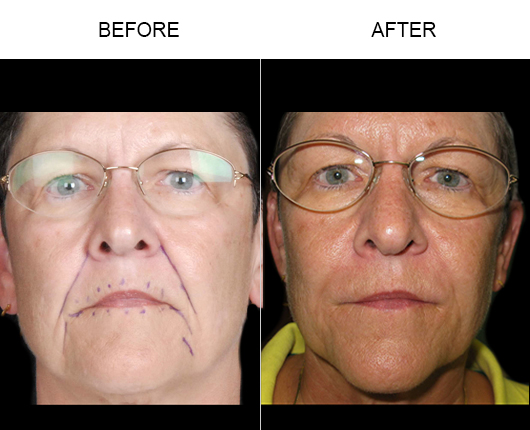 Before & After NaturalFill Facial Filler Treatment