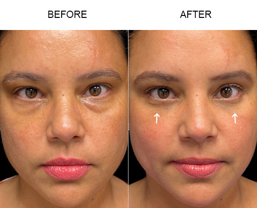 Eyelid Surgery Results Eyelid Surgery Results