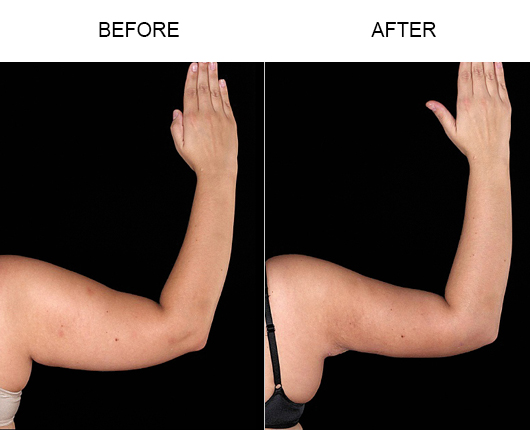 Bodytite Treatment Before And After Bodytite Treatment Before And After