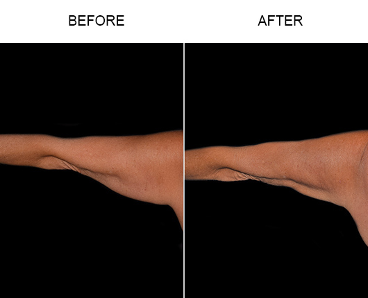 Bodytite For Arms Before & After Bodytite For Arms Before & After