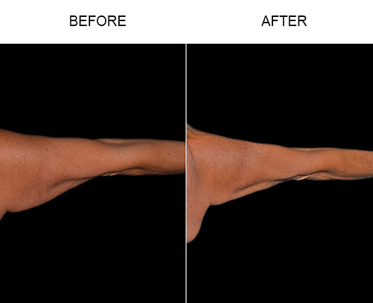 Bodytite Surgery For Arms Before And After Bodytite Surgery For Arms Before And After