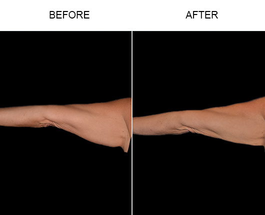Bodytite Surgery For Arms Before & After Bodytite Surgery For Arms Before & After