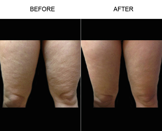 Before & After Bodytite Before & After Bodytite