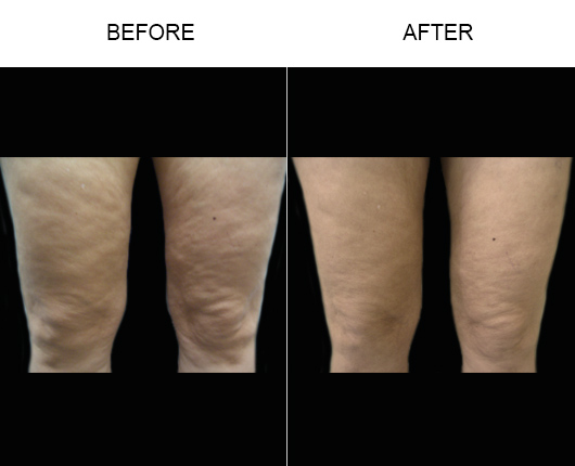 Before & After Bodytite Treatment Before & After Bodytite Treatment