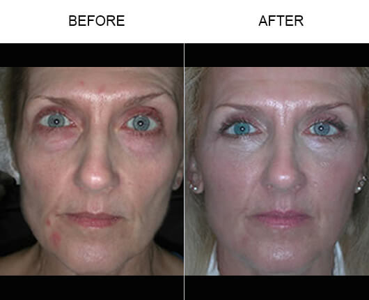 Cheek Lift Before And After Cheek Lift Before And After