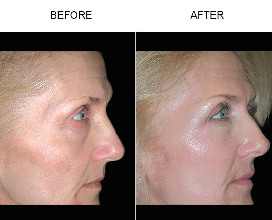 Cheek Lift Surgery Before And After Cheek Lift Surgery Before And After
