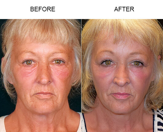 Cheek Lift Results Cheek Lift Results