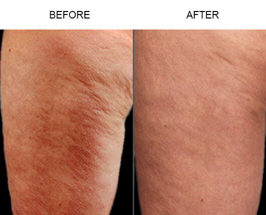 Cellulite Treatment Before And After