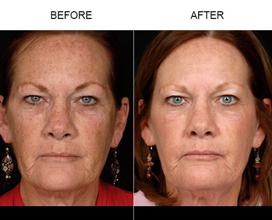 Laser Skin Resurfacing Results Laser Skin Resurfacing Results