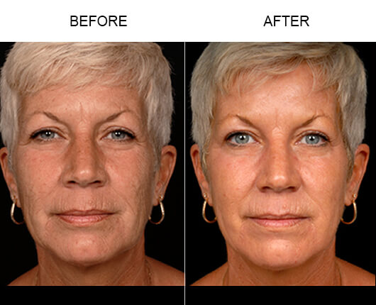 DOT Therapy Before And After DOT Therapy Before And After