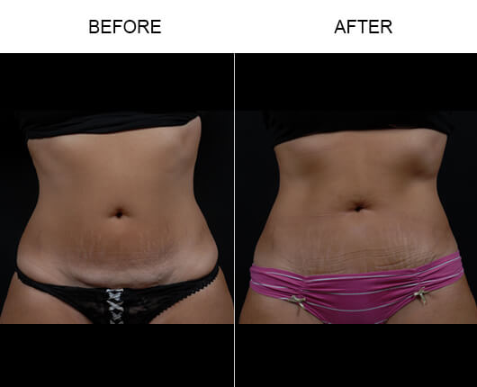 Mini Tummy Tuck Before And After Mini Tummy Tuck Before And After