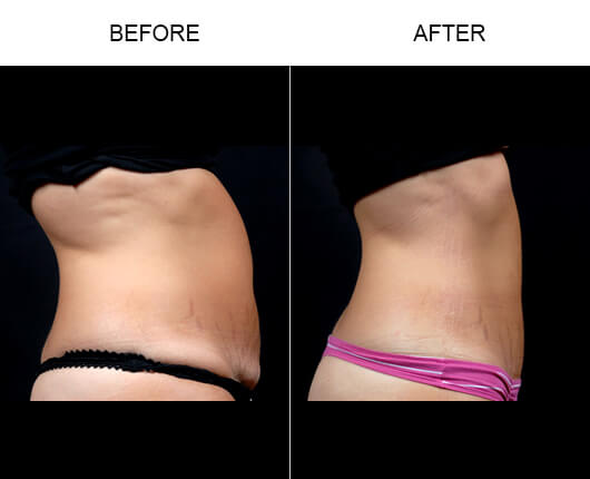 Mini Tummy Tuck Results Mini Tummy Tuck Results