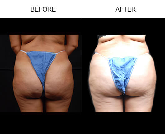 Buttocks Enhancement Before And After Buttocks Enhancement Before And After