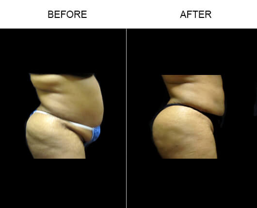 Buttocks Enhancement Results Buttocks Enhancement Results
