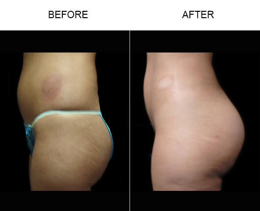 Naturalfill® Buttocks Enhancement Before And After Naturalfill® Buttocks Enhancement Before And After