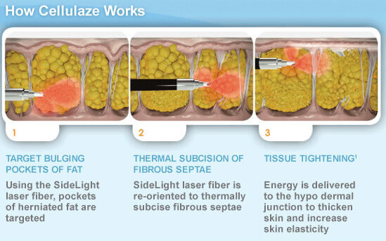 Cellulite Removal With Cellulaze™